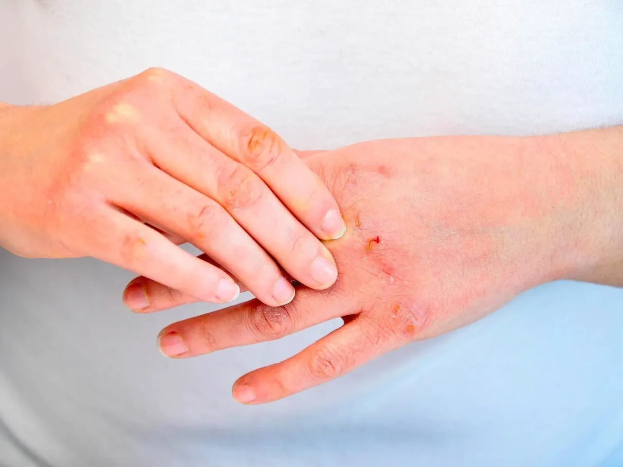 La psoriasi può davvero guarire? Ecco in quali casi scompare e cosa fare per riuscirci